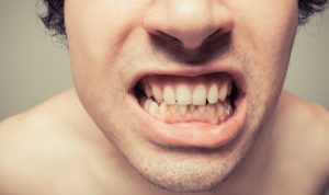 4 Dampak Buruk Karang Gigi Untuk Kesehatan