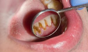 5 Cara Mudah Menghilangkan Karang Gigi Tanpa Perlu ke Dokter