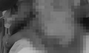 Alami Luka Bakar Parah, Bayi 10 Bulan di Candra Kecana Butuh Uluran Tangan Dermawan